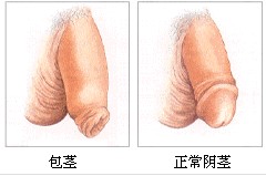包茎的图谱