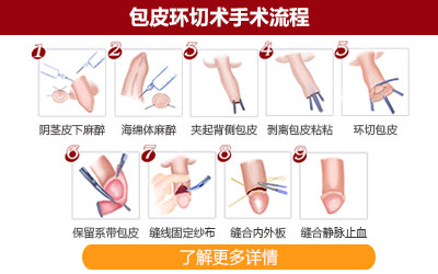 在韶关切包皮手术费用